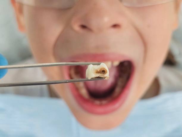 Best Dentist for Tooth Abscess  in Hernando, MS